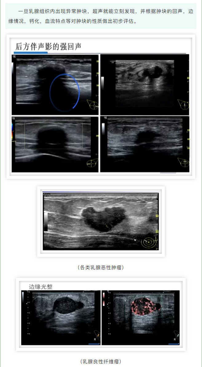 发现乳腺肿块，它俩帮了大忙！_03.jpg