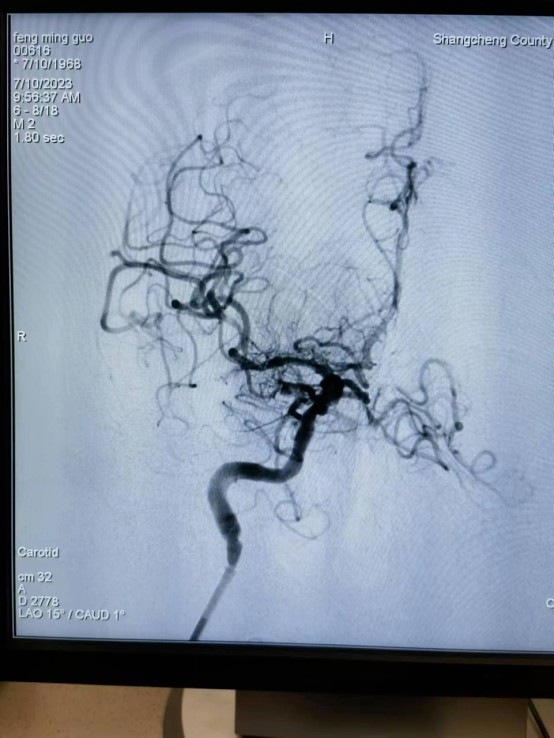2023-07-21_静脉溶栓桥接取栓，为急性脑梗死患者重开“生命通道”！_10.jpg
